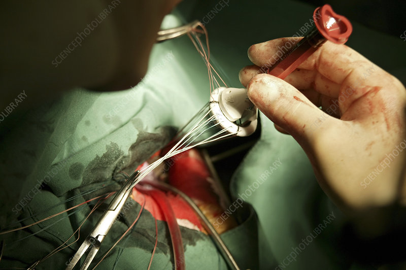 استبدال صمام القلب غير الجراحي